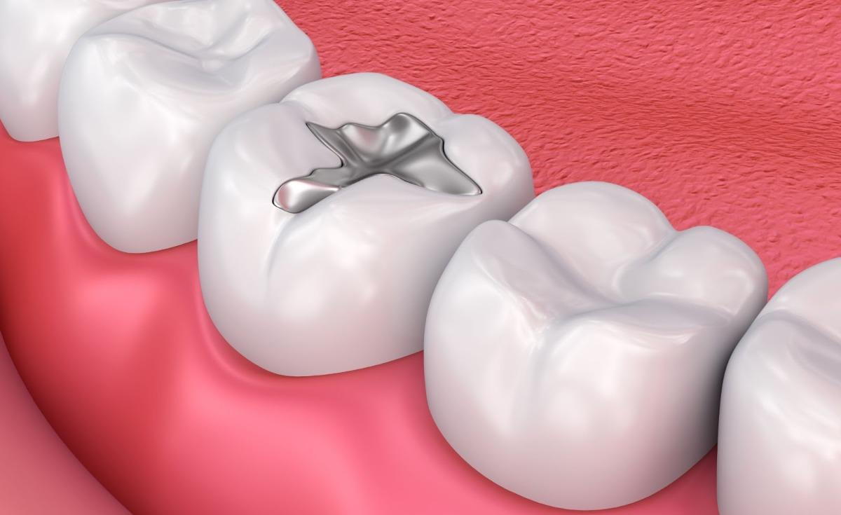 Illustration of a dental filling in a molar