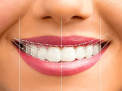 Digital smile design preview