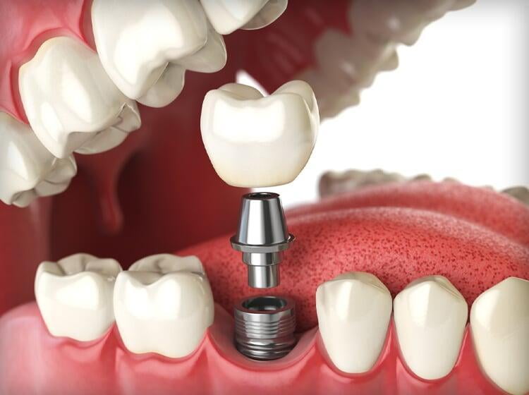 Dental implant treatment