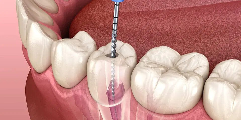 Illustration of a root canal procedure
