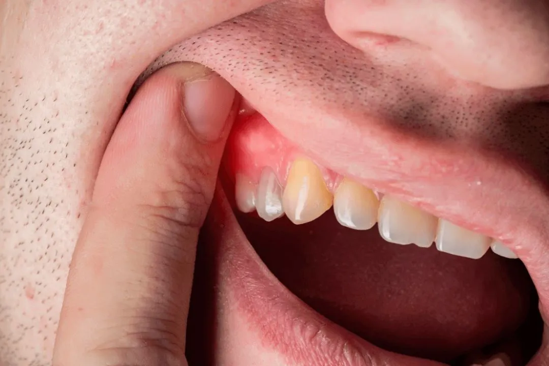Person pointing to a sensitive area of their gums