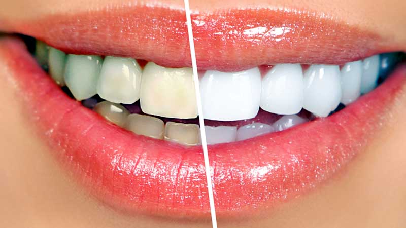Teeth whitening treatment